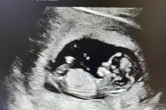 格鲁吉亚移植双胎，成功率到底咋样？一位老友的实在话