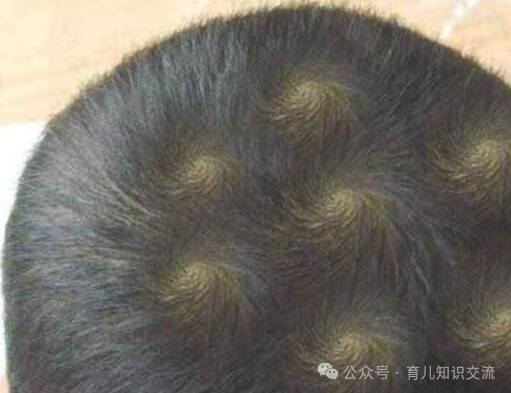 农村俗语“一旋横，二旋拧”，头上的旋有什么含义？看看科学依据