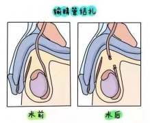 结扎了还可以做泰国试管婴儿吗？