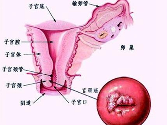 女性宫颈癌早期三处痒是哪些地方?早期这些症状表现不可大意