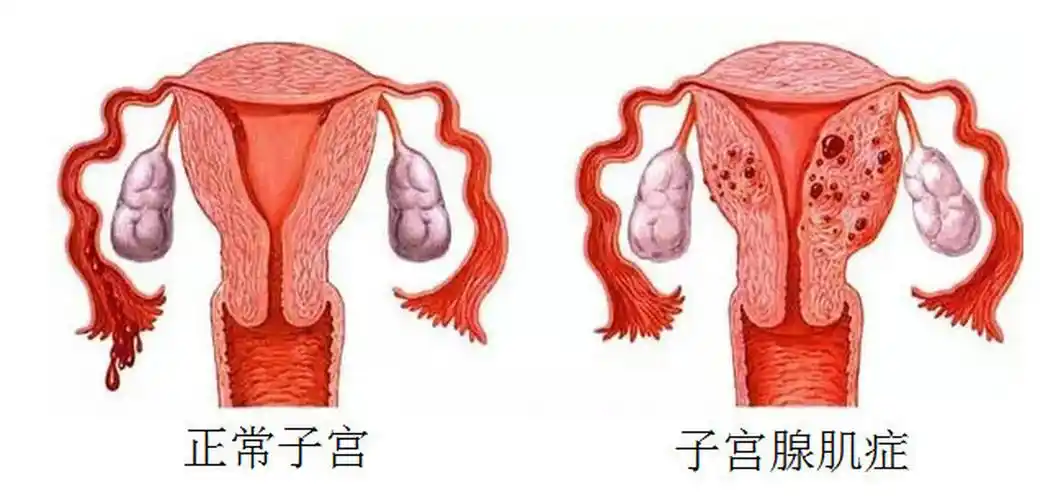 子宫腺肌症目前最好的治疗方法分享，打针吃药多运动都可以